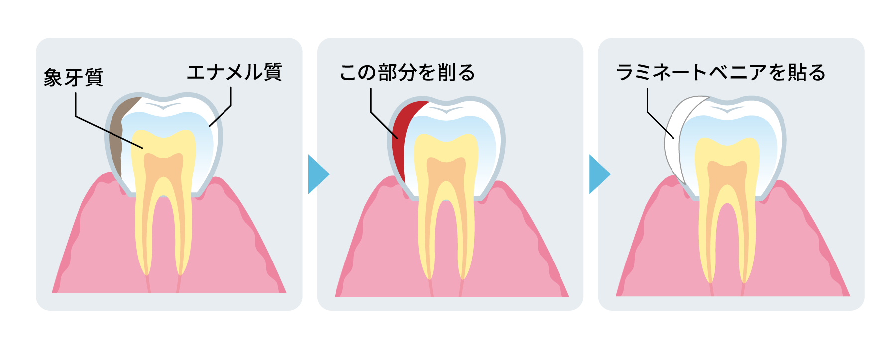 ラミネートべニア法